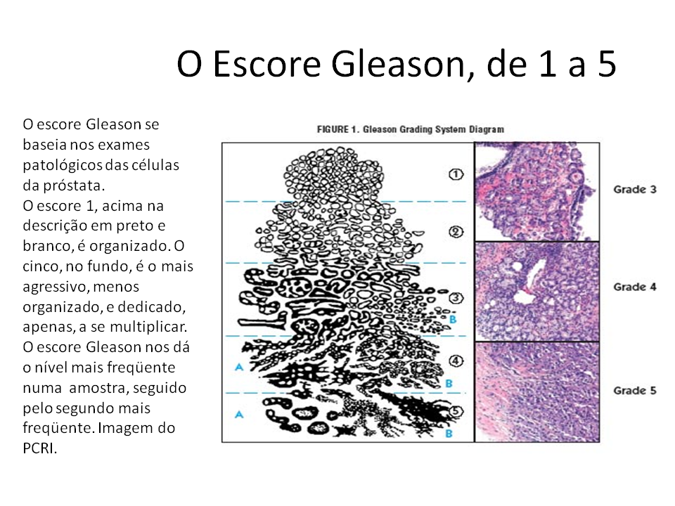 Глисон рак предстательной. Глисон 7 3+4. Классификация Глисона. Оценка по глисону. Gleason классификация.